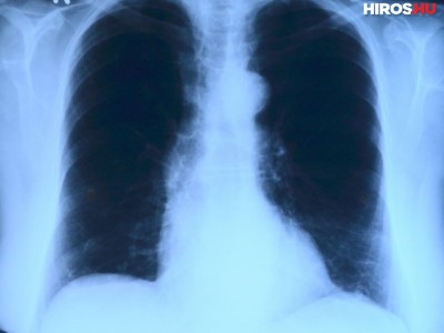 Átmenetileg nem működik a tüdőszűrő készülék a megyei kórházban
